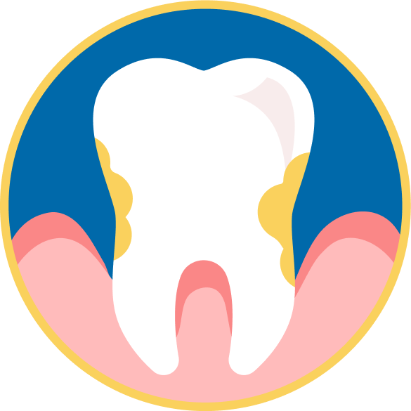 Tooth with worsened bacteria and deeper gum pockets 