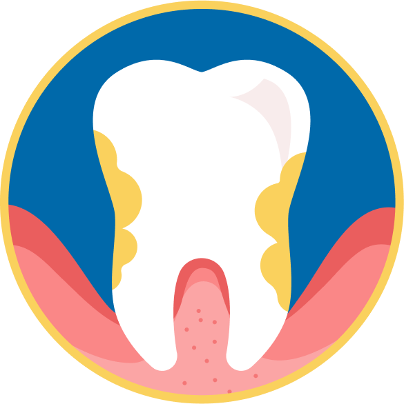 Tooth with high degree of bacteria and inflamed gum pockets 