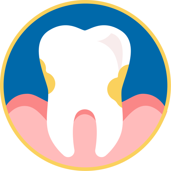 Tooth with bacteria along the gumline