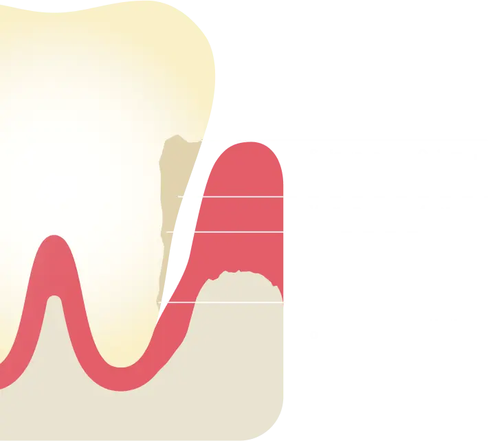 Chart showing severity of pocket depth infection at various millimeter depths