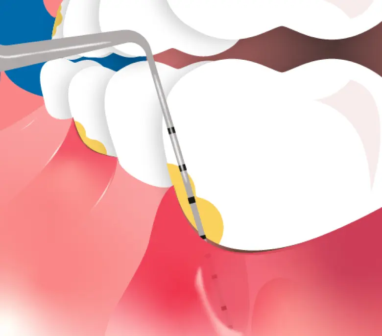 Measuring instrument being inserted into gum pocket