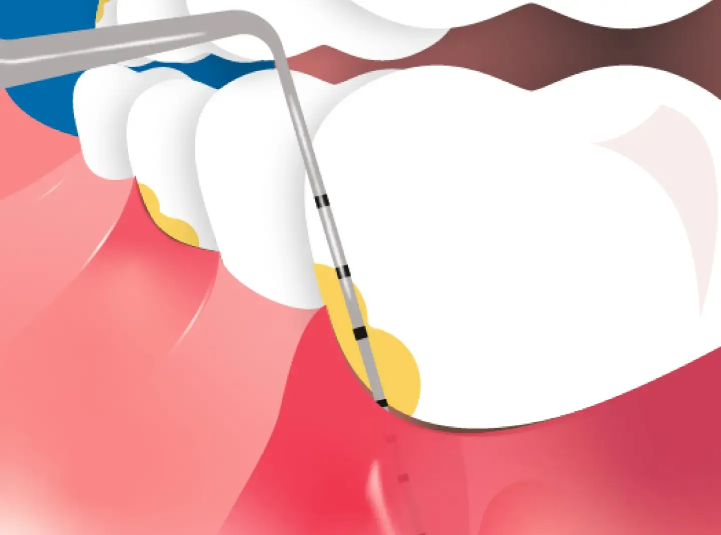 Measuring instrument being inserted into gum pocket